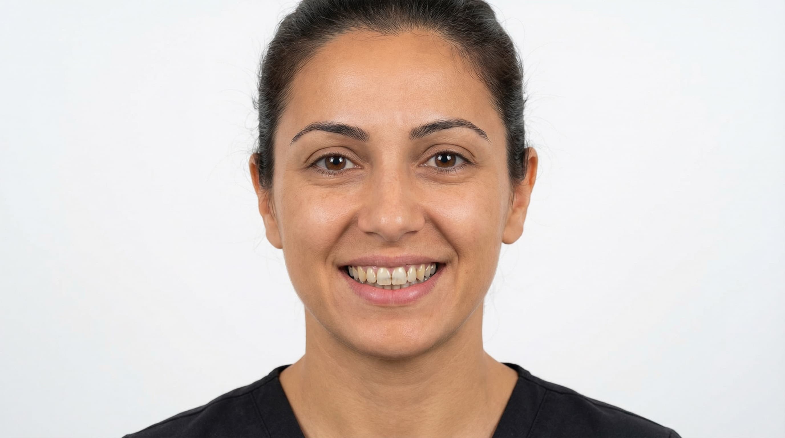 Blanqueamiento profesional - Antes