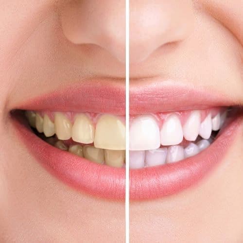 Blanqueamiento dental en Melilla