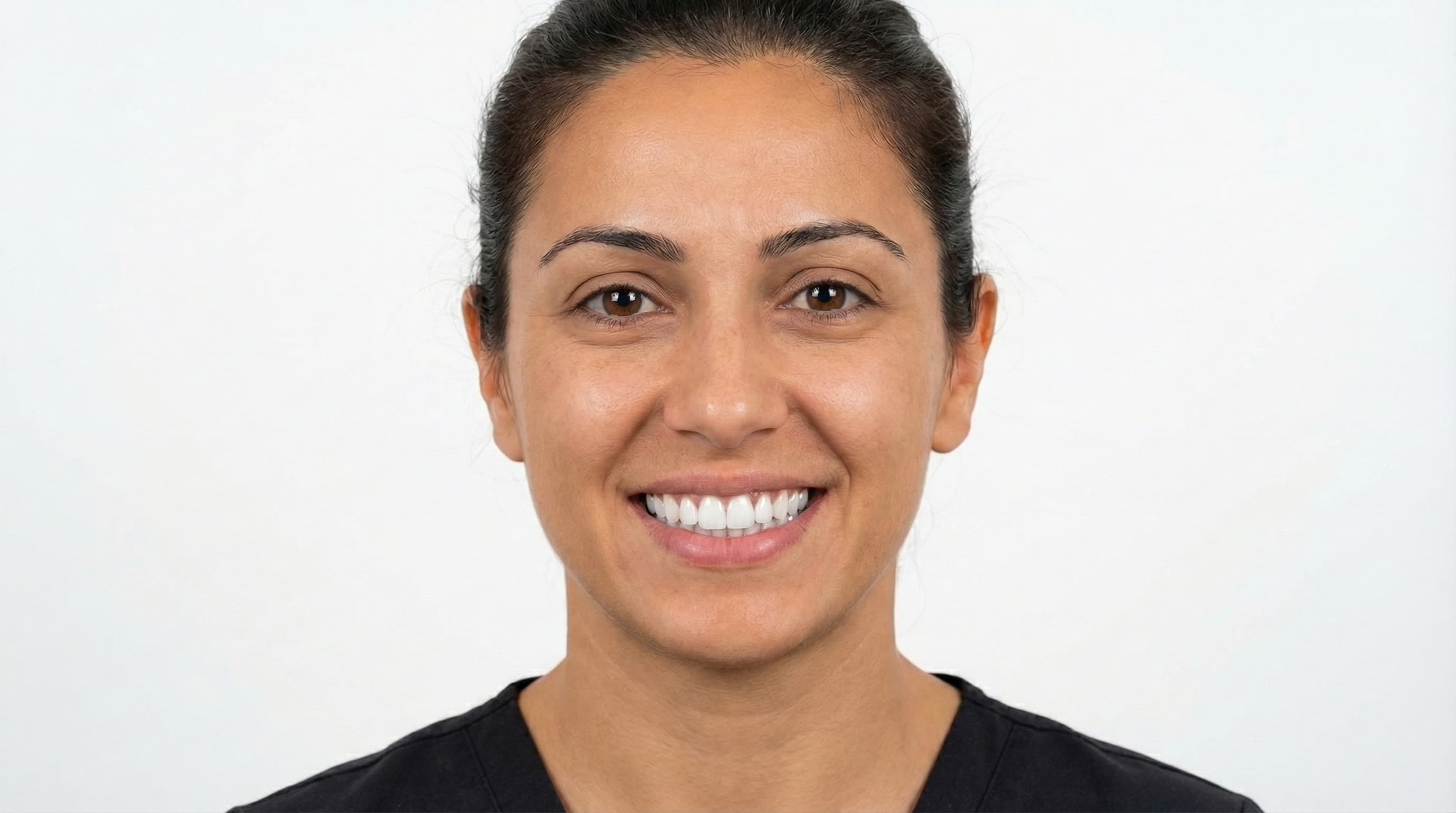 Blanqueamiento profesional - Después