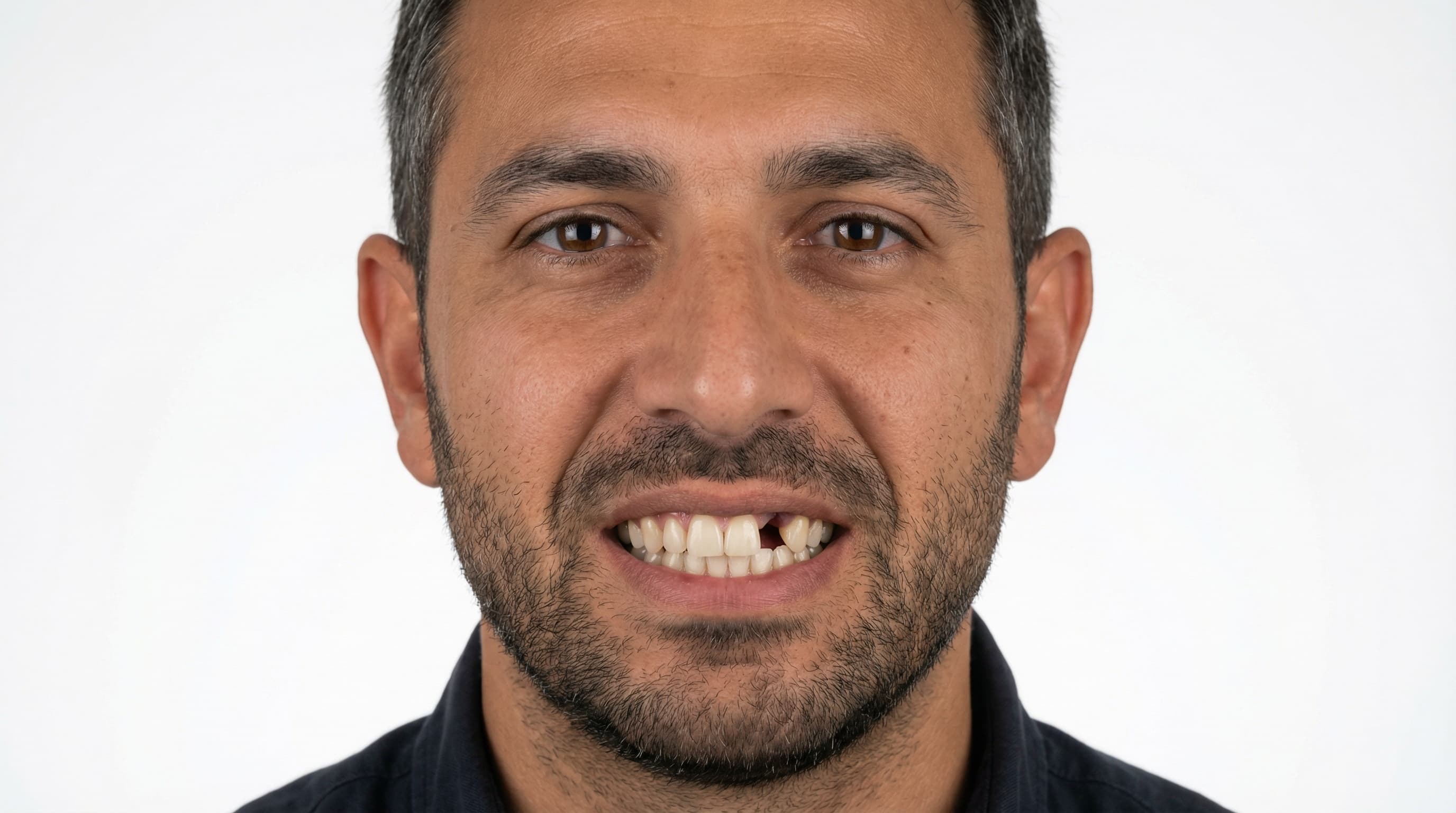 Recuperación de pieza dental - Después