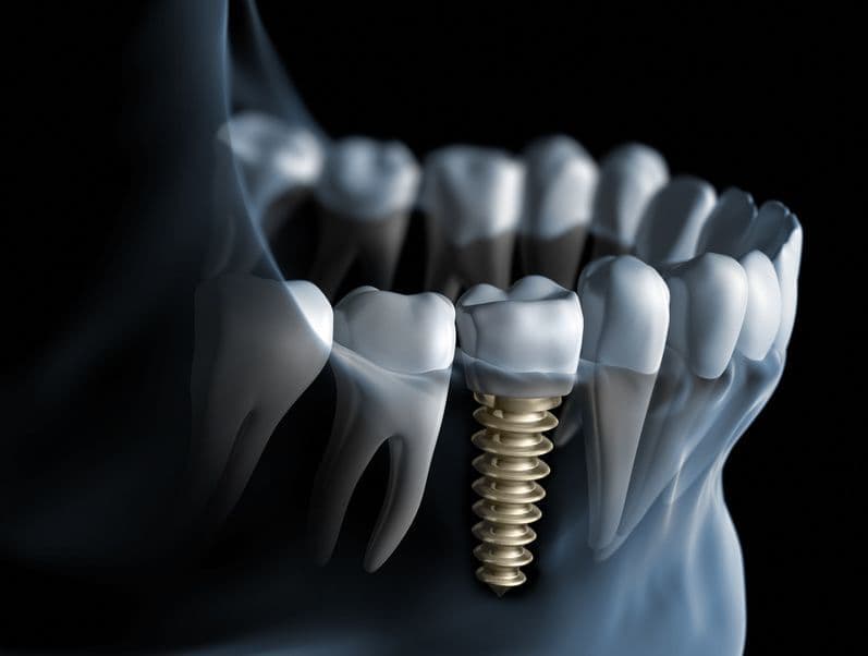 Implantes dentales en Melilla