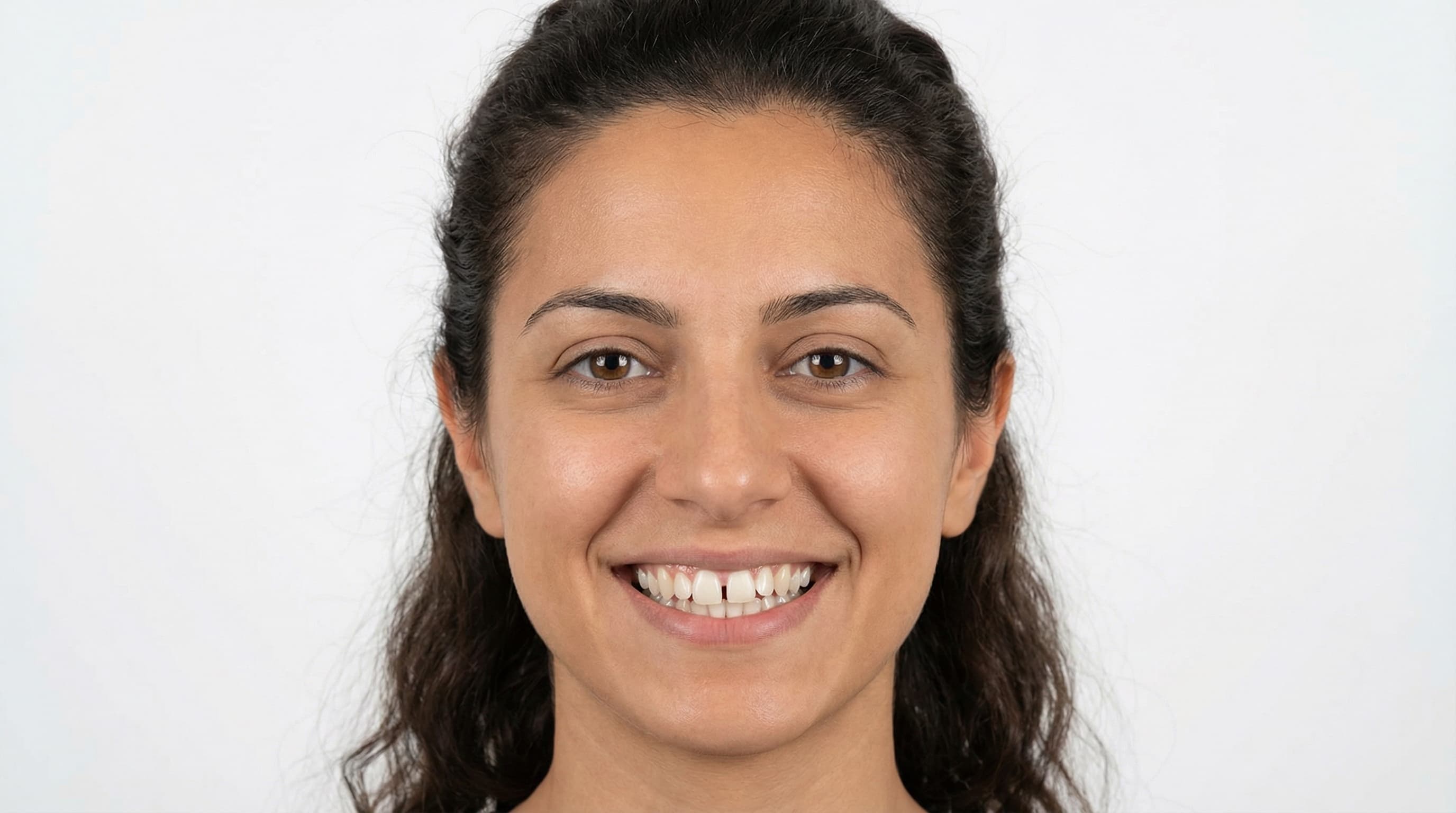 Alineación dental completa - Antes