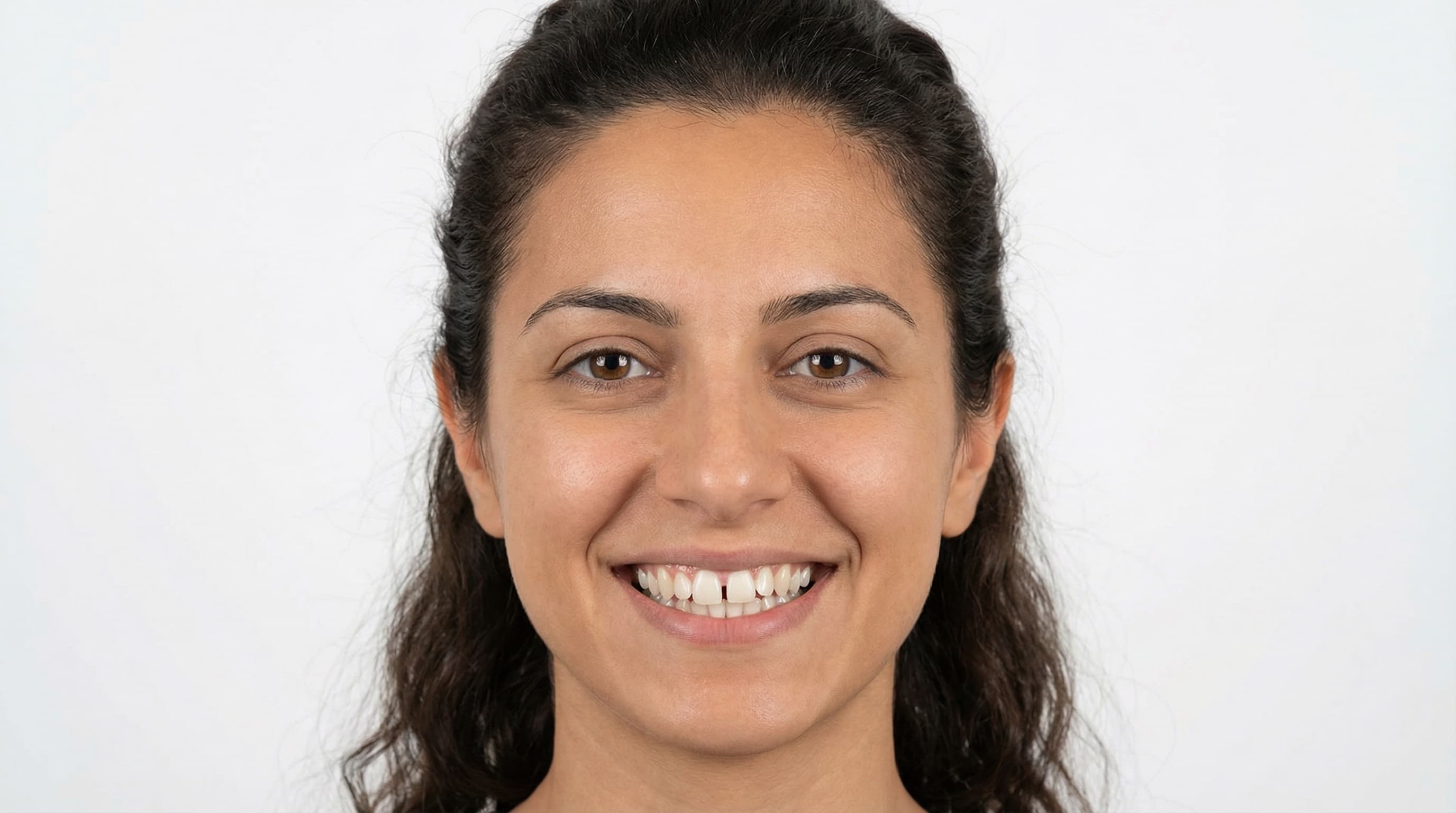 Alineación dental completa - Antes