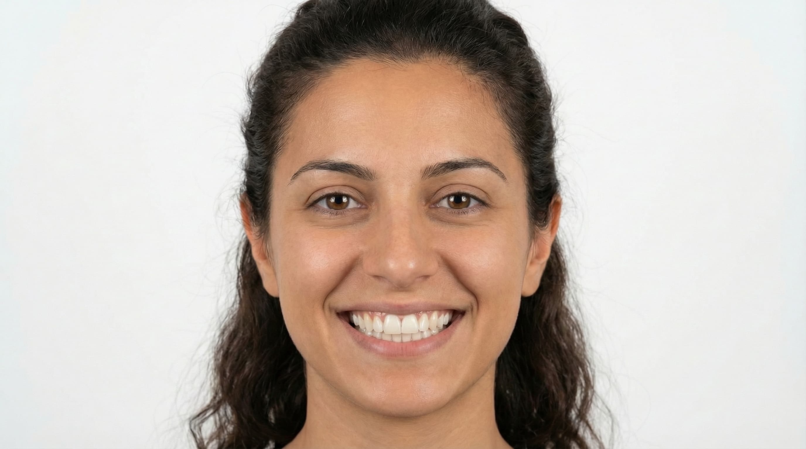 Alineación dental completa - Después