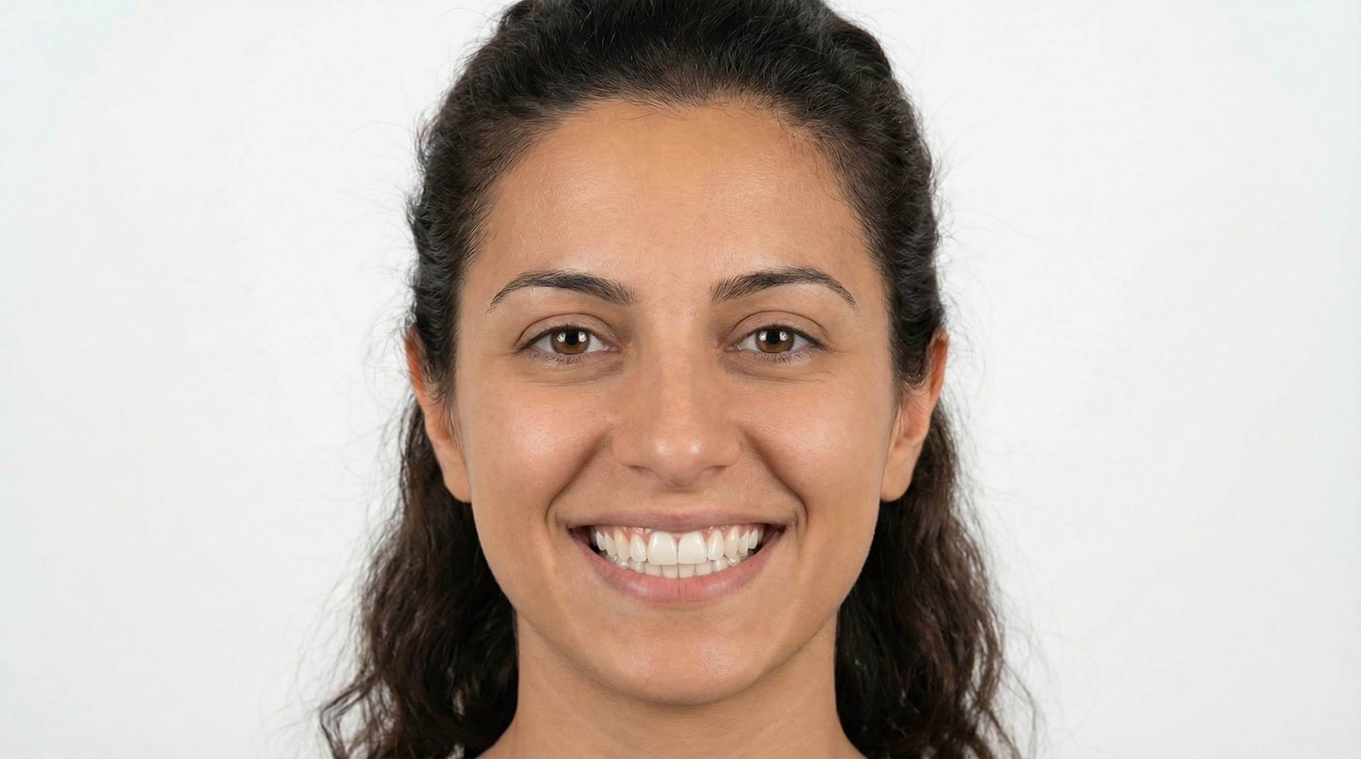 Alineación dental completa - Después